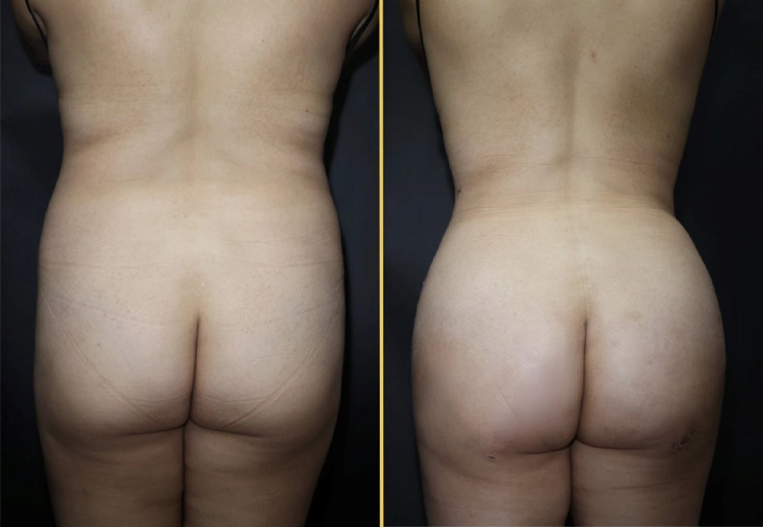 Before and after rear view displaying buttock enhancement and body contouring results