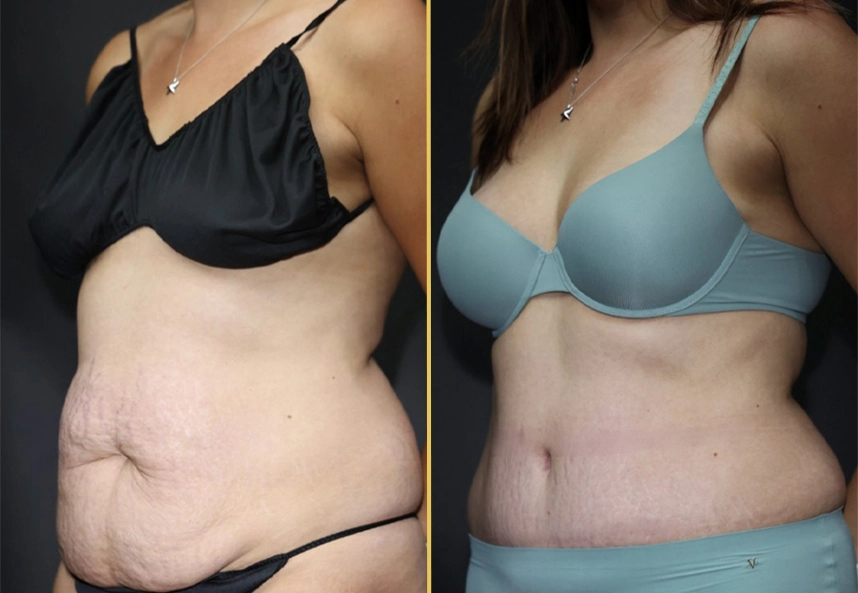 Before and after frontal view showing abdominal and torso contouring results
