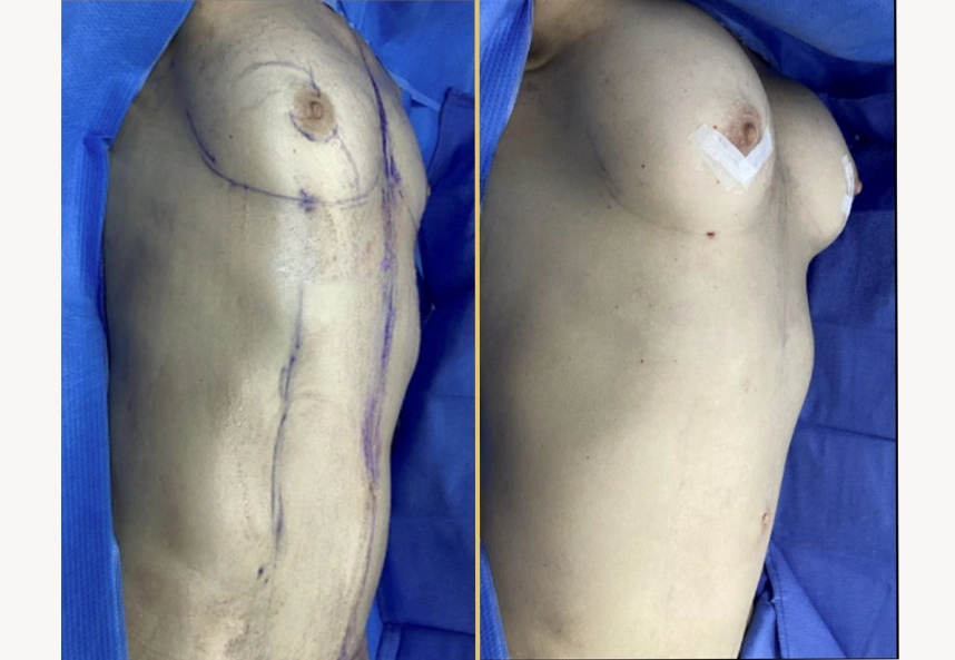 Before and after side view of breast showing surgical marking and post-procedure result