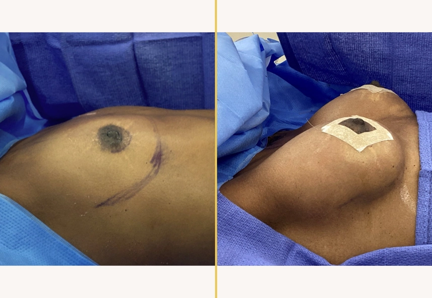 Pre and post-operative breast surgery case 738 with surgical markings on measurement tape