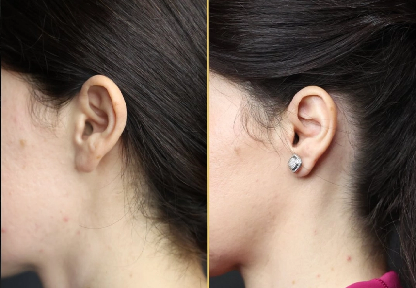 Before and after ear surgery, rear side view showing earlobe and piercing