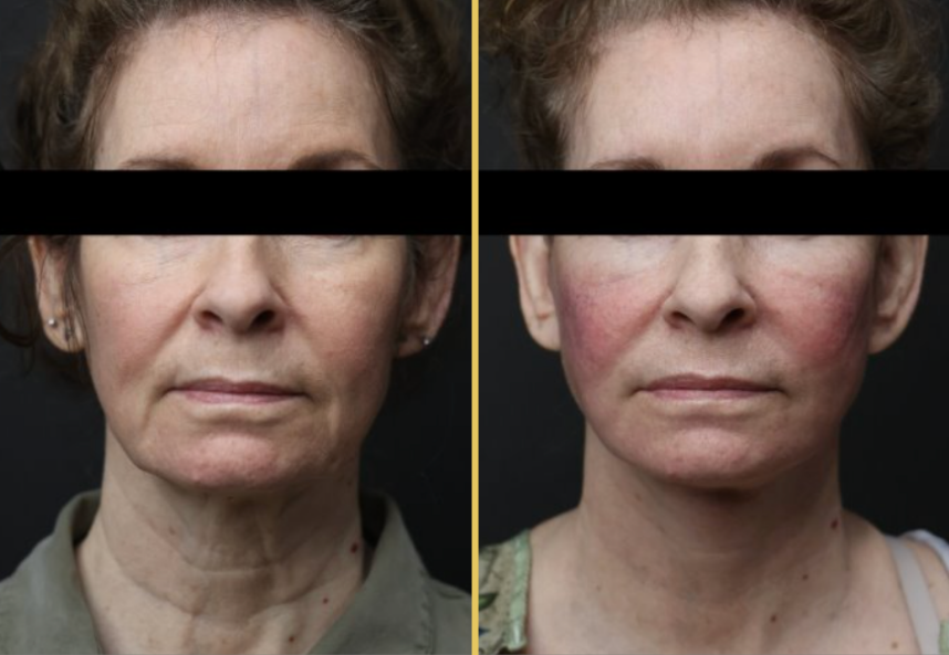 Before and after forehead and face comparison showing reduced wrinkles and improved skin texture