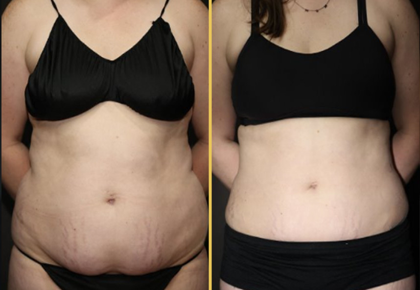 Before and after frontal view of abdomen showing flatter midsection