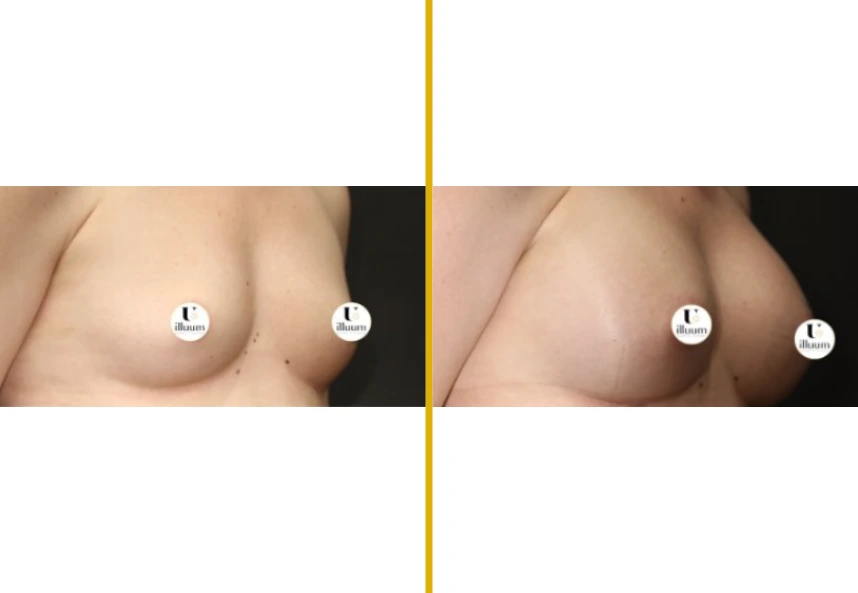 Before and after front-facing breast comparison with illium logos