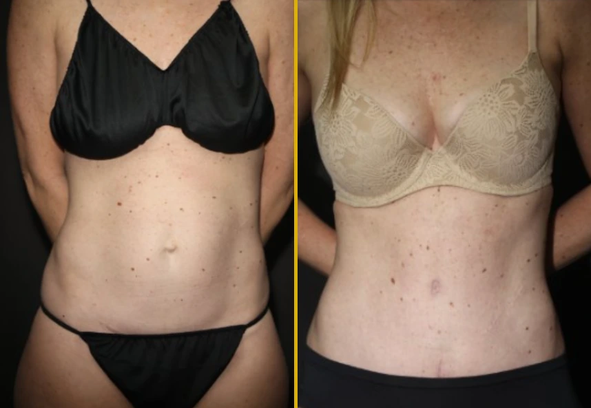 Before and after frontal torso comparison showing body contouring results