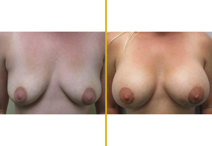 Before and after saline breast augmentation, frontal view showing improved symmetry and fullness