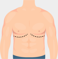 Types of FTM Top Surgery Incisions: Double Incision Banner