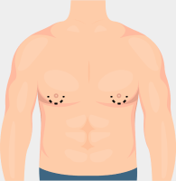 Types of FTM Top Surgery Incisions: Keyhole Banner