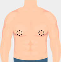 Types of FTM Top Surgery Incisions: Periareolar or Donut Banner