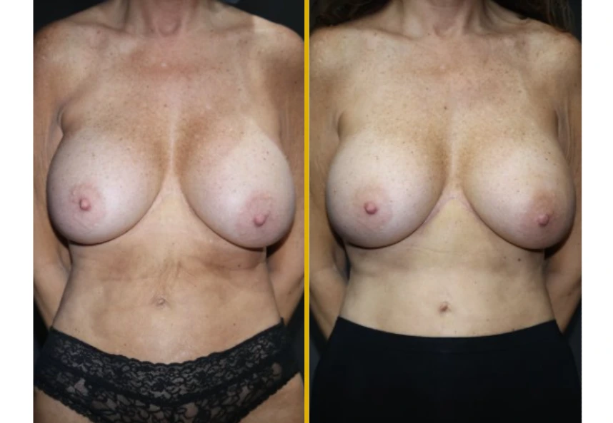 Before and after breast augmentation, front view comparison