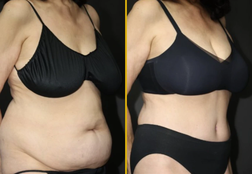 Before and after front view showing abdominal contour and definition