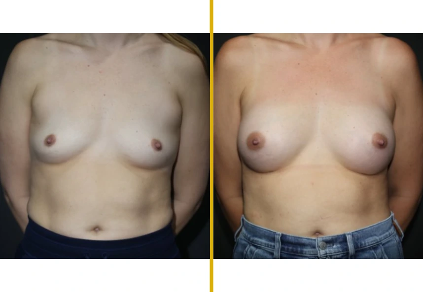 Before and after breast augmentation, 37-year-old patient, front view