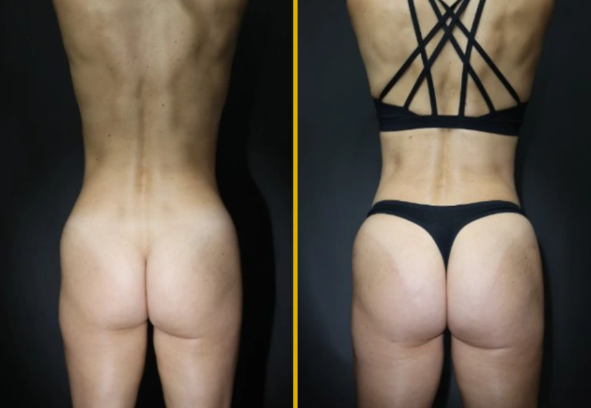 Before and after case 789: rear view showing enhanced buttock contour and projection