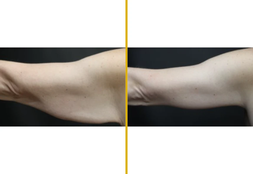 Before and after case 789: side-by-side arm comparison showing reduced laxity
