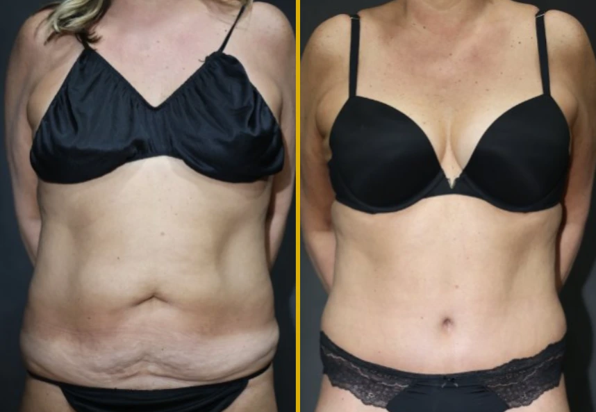 Before and after cosmetic surgery case 789: front torso view showing improved abdominal contour and skin tightness