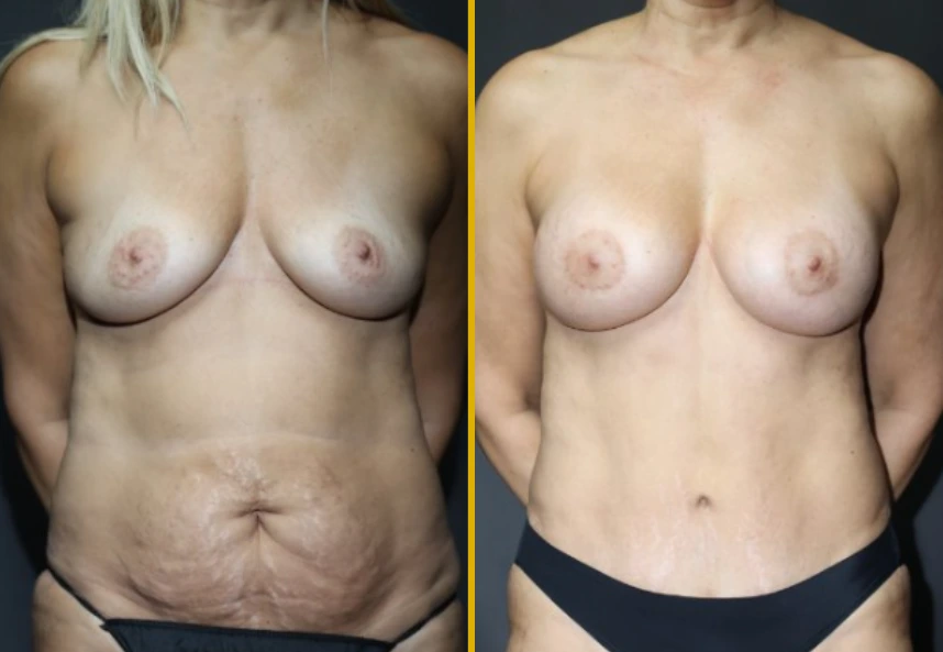 Before and after comparison: left shows torso with excess abdominal skin, right shows improved abdominal contour after surgery
