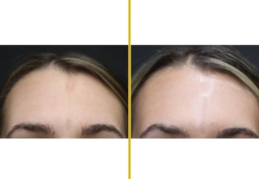 Before and after forehead treatment showing reduced wrinkles and improved skin texture