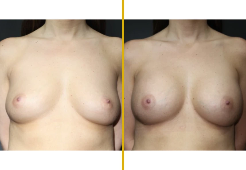 Before and after breast augmentation for 39-year-old patient, front view