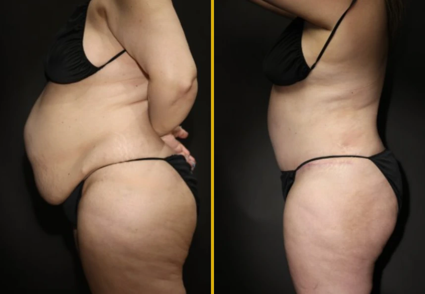 Before and after side profile showing body sculpting results with enhanced contours