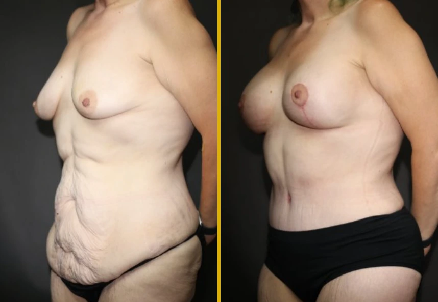 Before and after front view of breast and abdominal surgical results