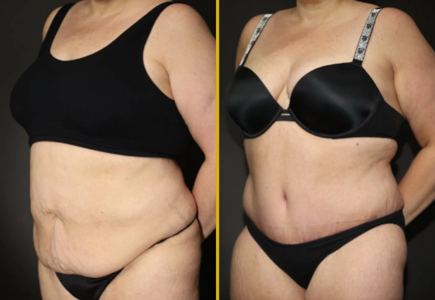 Before and after side view showing abdominal contouring and breast augmentation results
