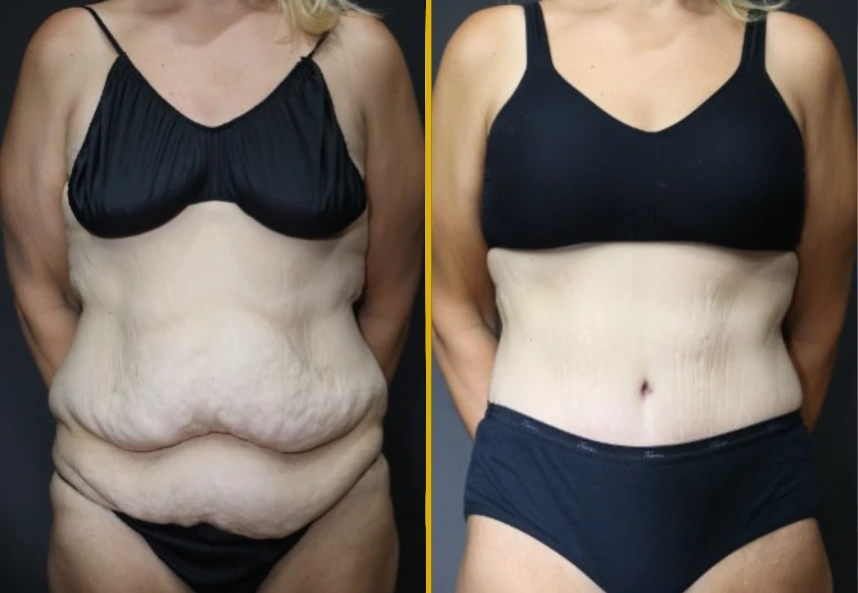 Before and after front view of torso showing body contouring results