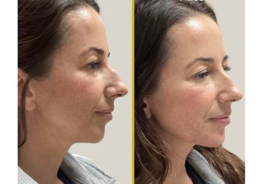 Before and after side profile comparison of injectable treatment results