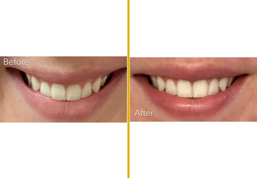 Before and after smile showing fuller lips with enhanced lip contour