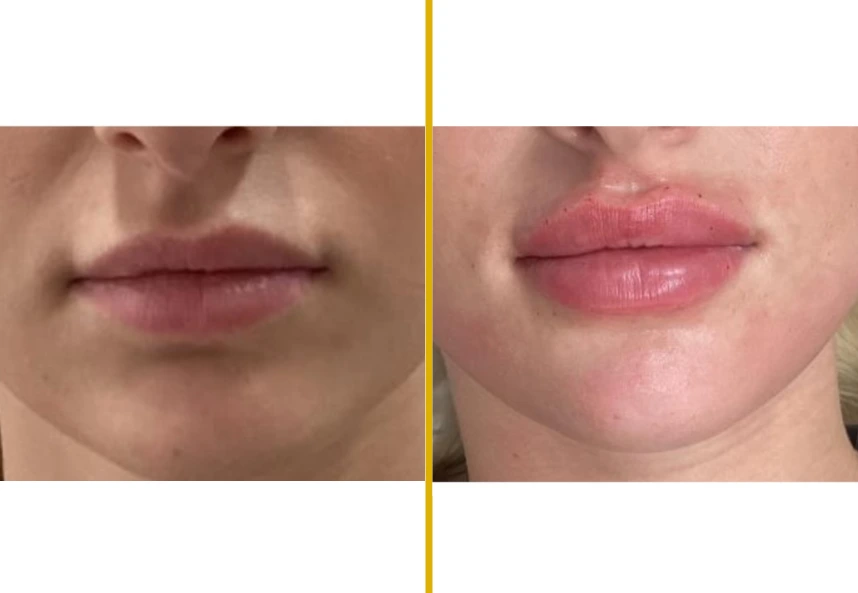 Before and after lip enhancement comparison showing fuller lip appearance