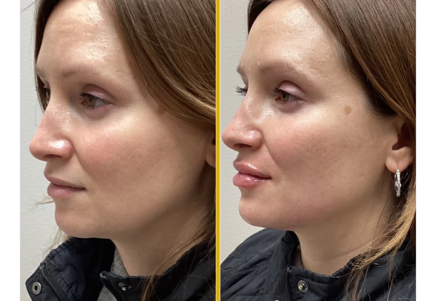 Before and after profile view showing increased lip fullness and definition