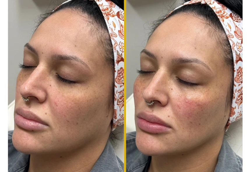 Before and after three-quarter view showing smoother skin texture and reduced acne