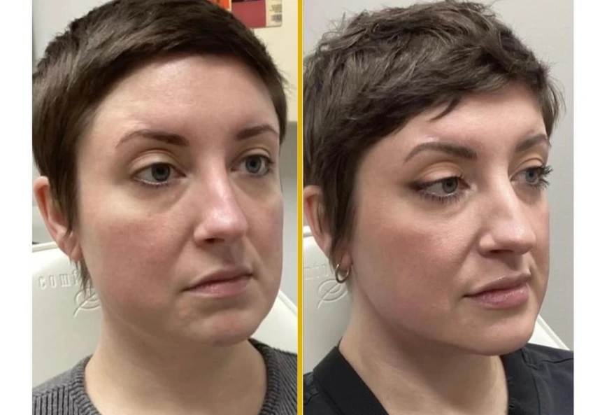 Before and after laser microneedling: patient's face in profile showing improved skin quality and reduced puffiness