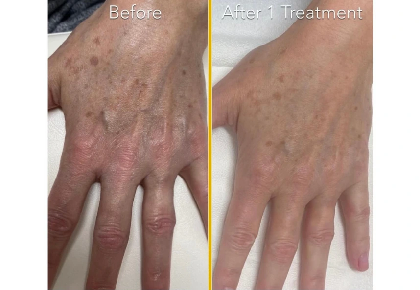 Before and after laser microneedling: patient's hand showing reduced age spots and improved skin tone after 1 treatment