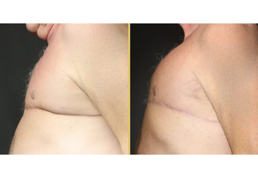 Case 1004 before and after side view showing torso contour changes