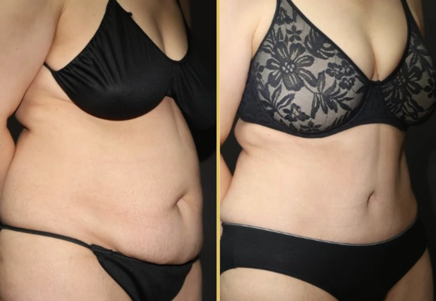 Before and after oblique view of torso showing body contouring outcomes