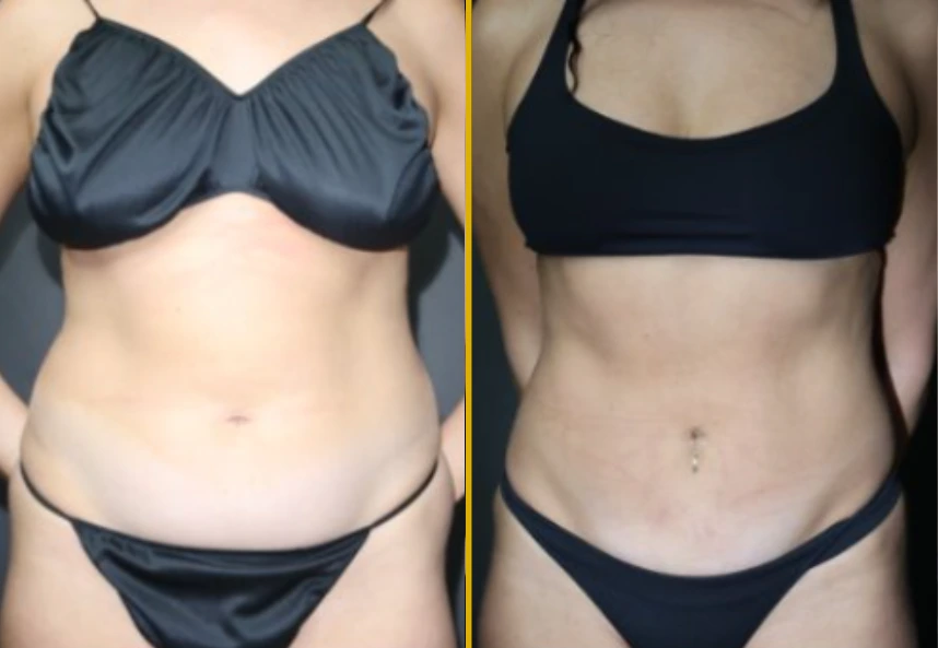 Before and after frontal view comparing abdominal contour and definition