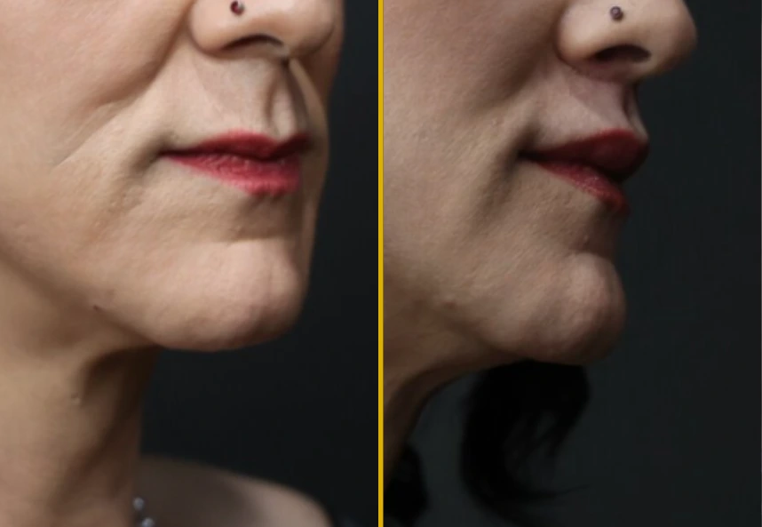 Side profile before and after showing fuller lips and refined facial proportions