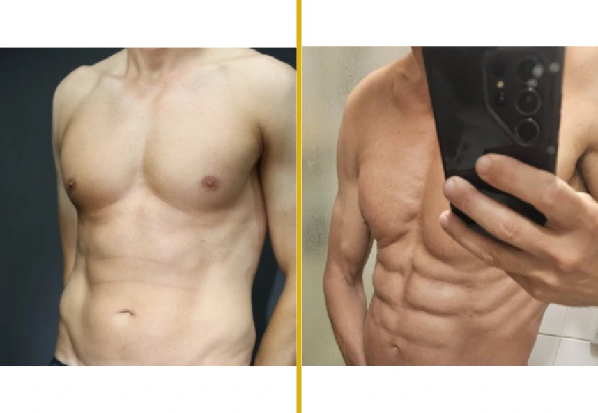 Before and after comparison of male torso showing chest and abdominal contouring results