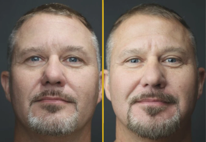 Male face-on comparison showing before and after treatment results for Case 819