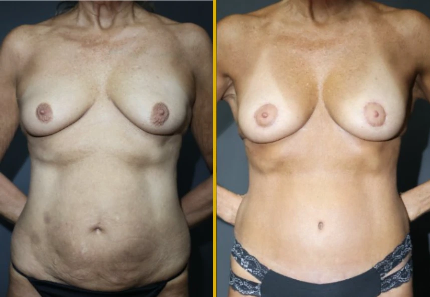 Before and after body contouring results showing front torso view
