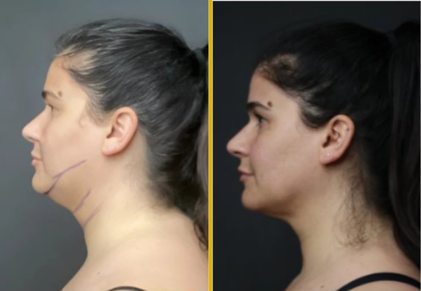 Before and after profile view showing reduced jawline and neck contour