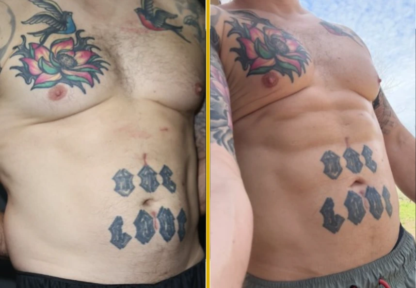 Before and after torso showing tattoo removal results on chest and abdomen