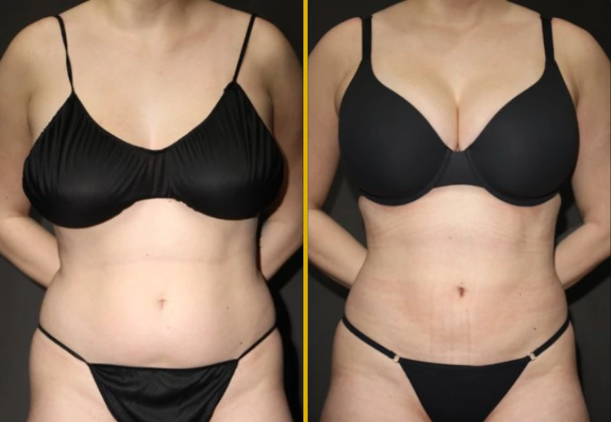 Before and after front view of chest and abdomen showing results of body contouring treatment