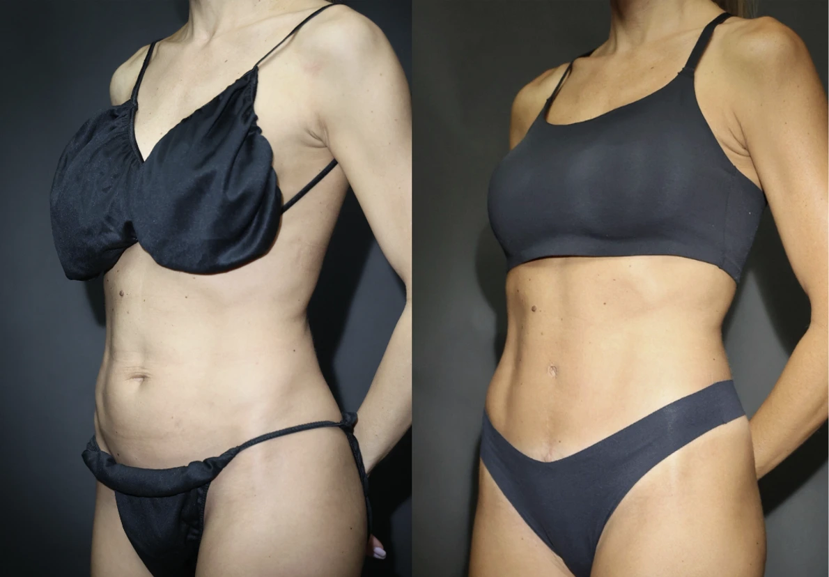 Before and after body contouring comparison, frontal view