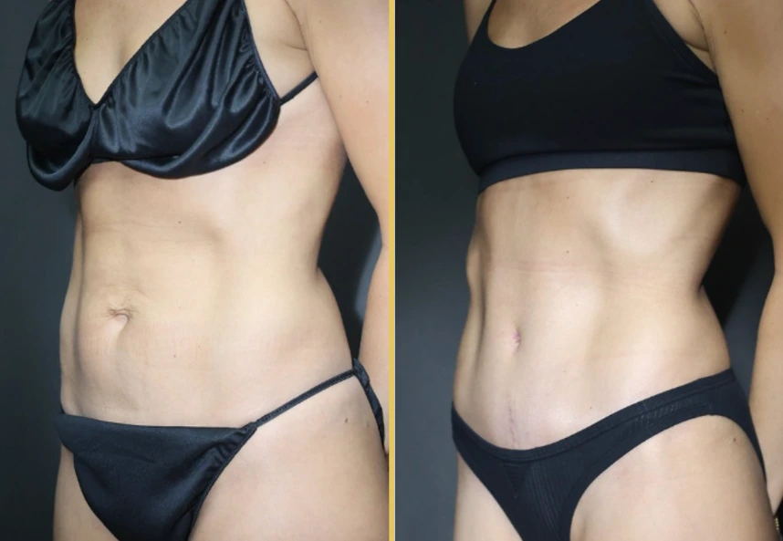 Before and after oblique torso views showing body contouring improvements