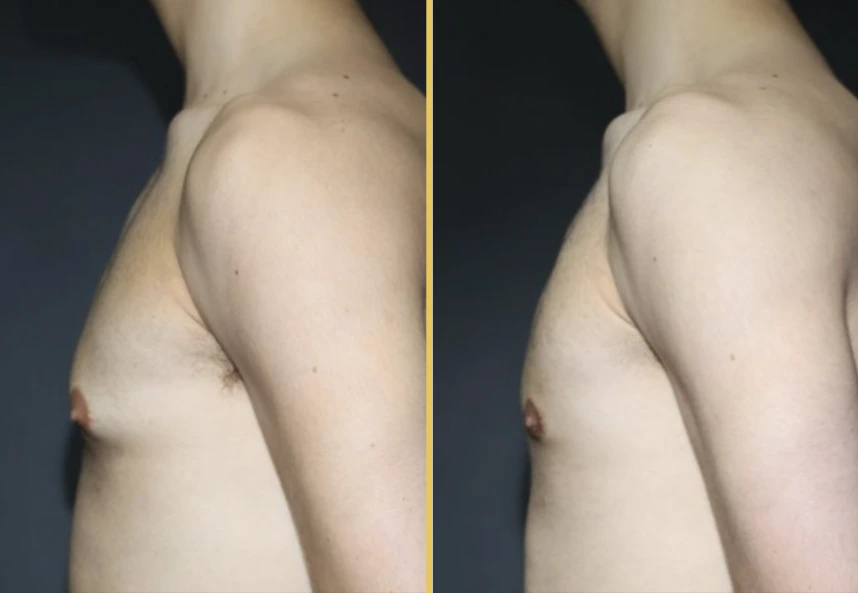 Case 1005 before and after side view of male torso