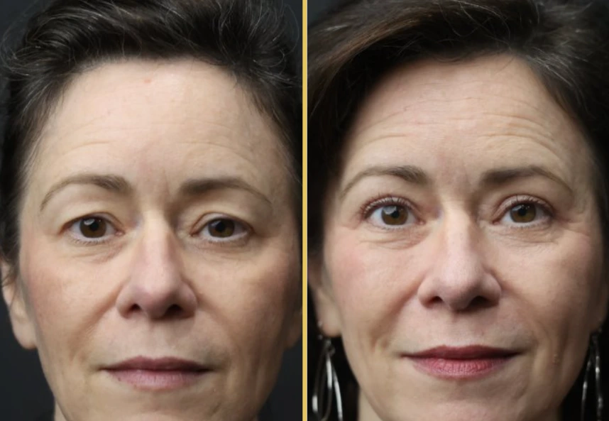 Case 1006 before and after front view of female face