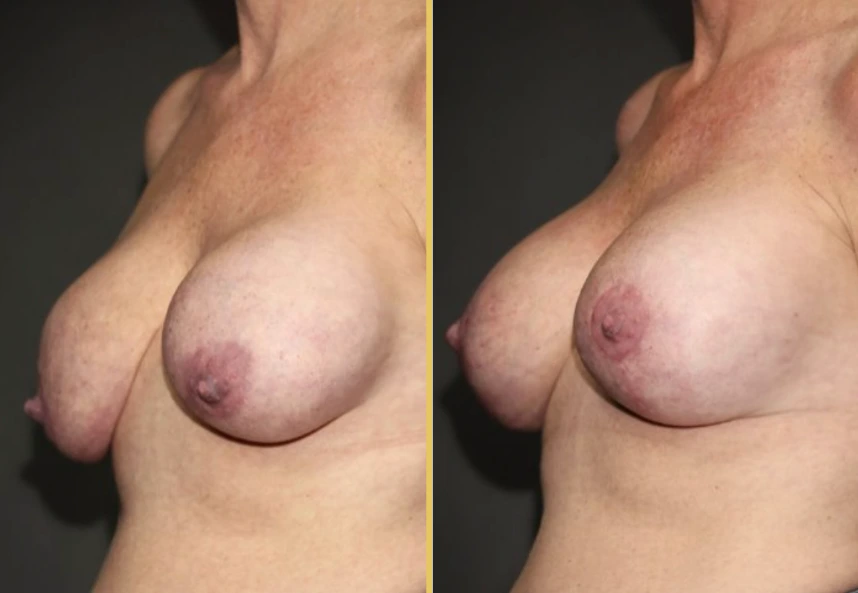 Case 1007 before and after oblique front view showing breast augmentation results