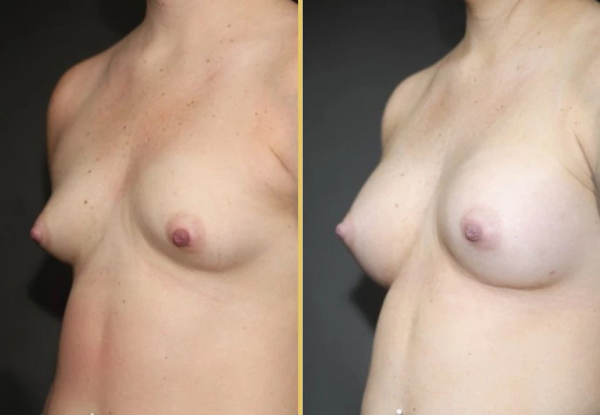 Case 1008 before and after breast augmentation, oblique left view