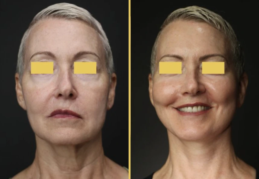 Before and after facial rejuvenation case 873, front view showing improved skin texture and definition